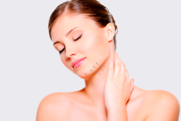 Double chin liposuction